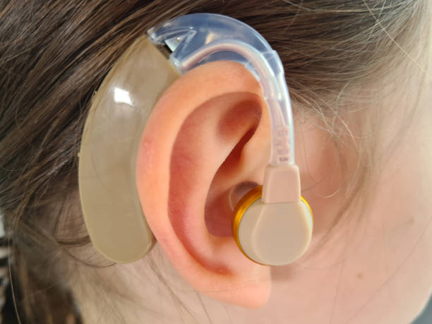 cochlear implant