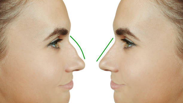 septoplasty