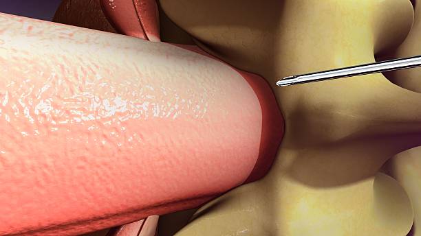 Thyroplasty